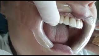 As vantagens dos Implantes Dentários