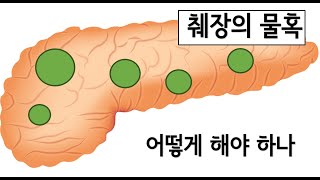 췌장에 물혹(낭종)이 생겼다는데, 어떻게 해야 하나