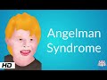 Angelman Syndrome, Causes, Signs and Symptoms, Diagnosis and Treatment.