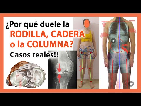 Dolor de Rodilla,