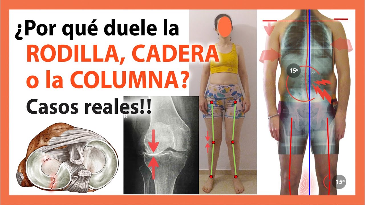 Dolor de Rodilla, Espalda y Cadera 🛑 Descubre las Causas REALES con Casos REALES 🤯