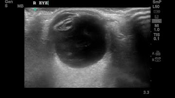 Ocular Ultrasound: Posterior vitreous detachment