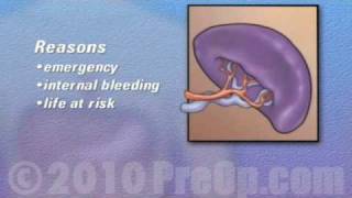 PreOp® Patient Education Spleen Removal Laparoscopic Splenectomy 2