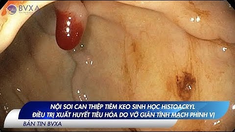 NỘI SOI CAN THIỆP TIÊM KEO SINH HỌC ĐIỀU TRỊ XUẤT HUYẾT TIÊU HÓA DO VỠ GIÃN TĨNH MẠCH PHÌNH VỊ |BVXA