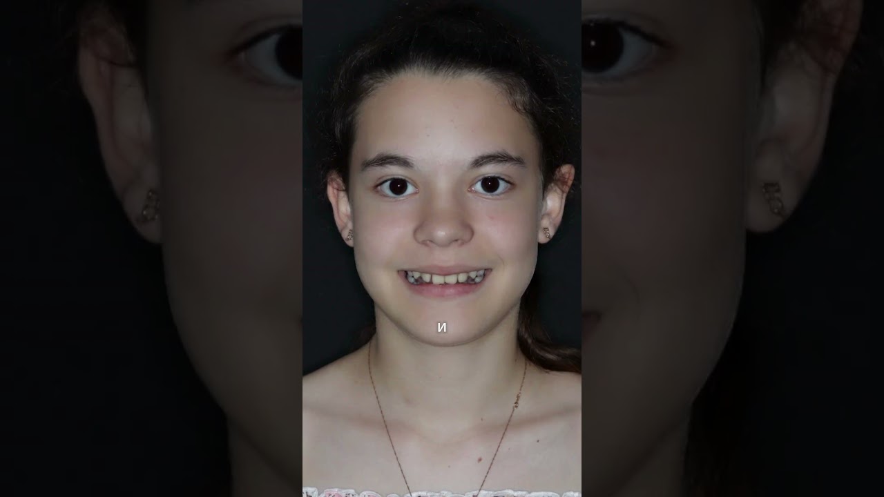 👉 Глубокий прикус. Клинический случай Belgravia Dental Studio