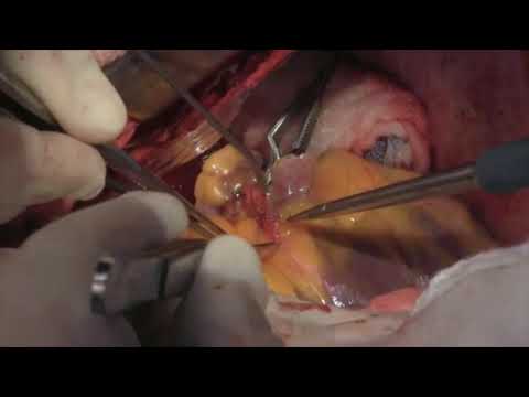 Coronary Artery Bypass Surgery: Internal Mammary Arteries (Graphic)