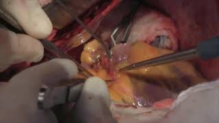 Coronary Artery Bypass Surgery Internal Mammary Arteries Graphic