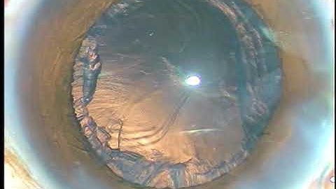 "Lens Tilt Technique" for Soft Cataract Phacoemulsification - PM, 21/3/2018