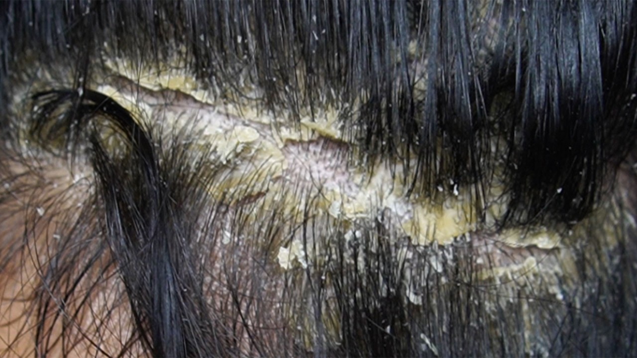 relaxing Treatment and Dandruff Removal Scratching#23