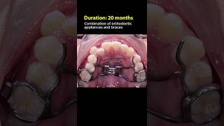 How palatal expanders and braces work over 20 months? # #braces #orthodontist #orthodontics #dentist