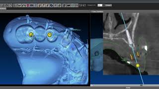 Full Edentulous Maxilla Implant Placement