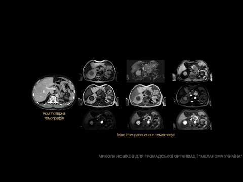 Вебінар з радіологічної візуалізації для пацієнтів з меланомою