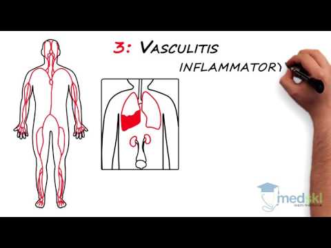 Rheumatology – Polyarticular Pain: By Lori Albert M.D.