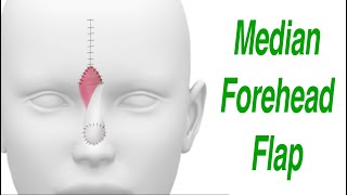 Median Forehead Flap for Nasal Defect Reconstruction