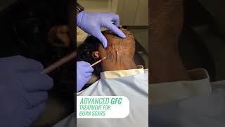 Advanced Gfc Treatment For Burn Scars Anew Aesthetic Clinic Bangalore, Goa And Maldives