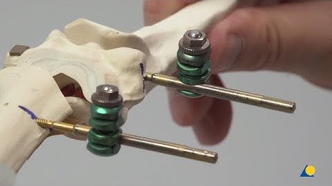 Humerus, Distal—Supracondylar Fracture —Fracture Fixation Using the Small External Fixator