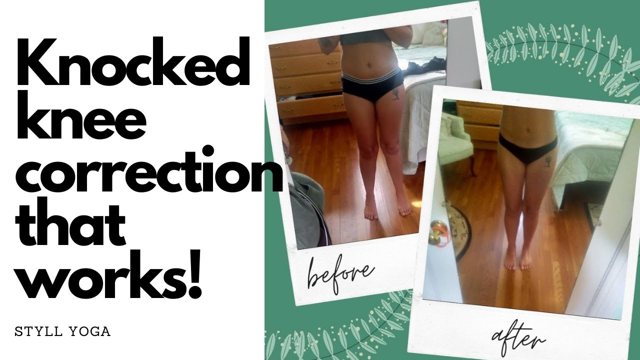Knocked Knees Correction (Part 2) YouTube