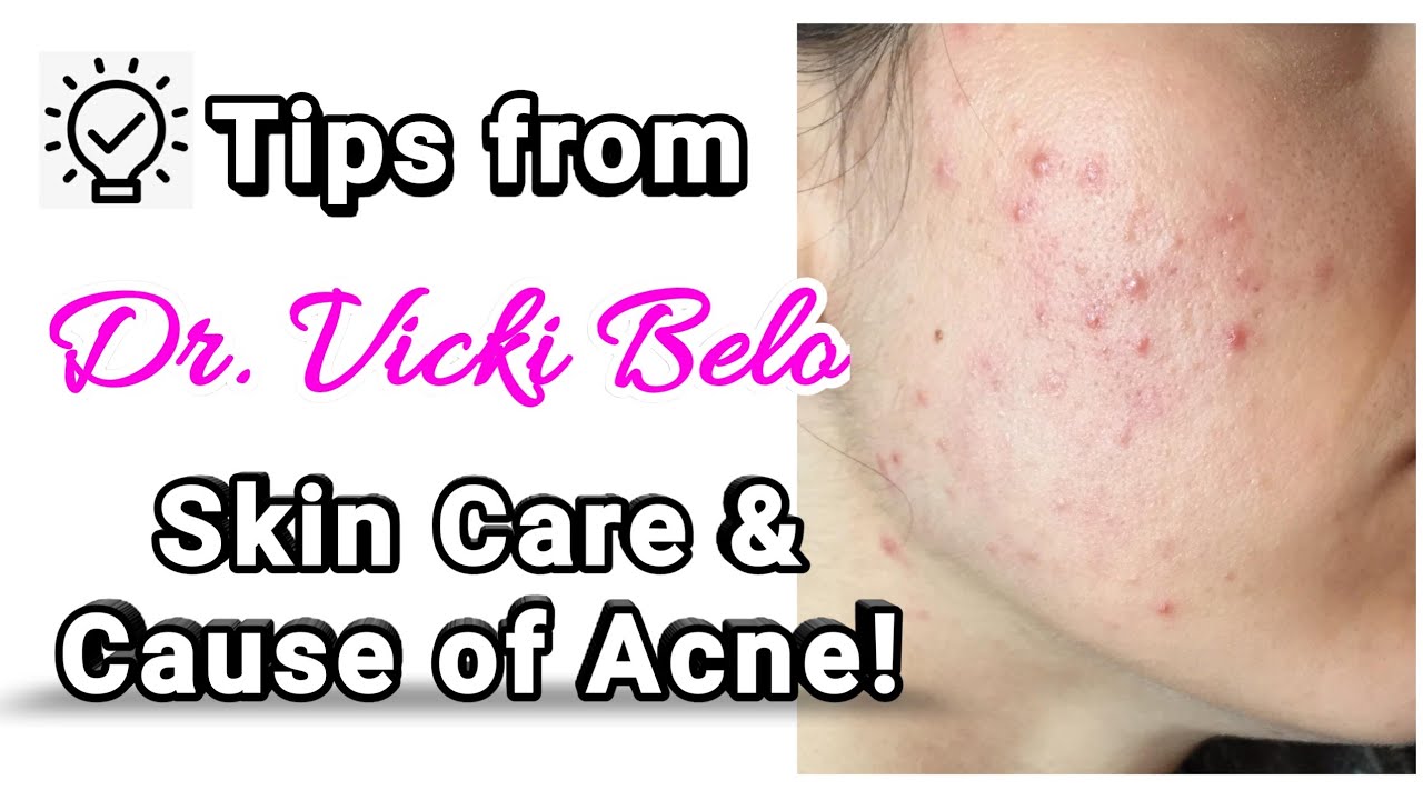 Tips from Dr. Vicki Belo Skincare and Cause of Acne by jemliz vlogs