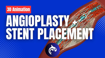 Angioplasty and Stent Placement - 3D Animation