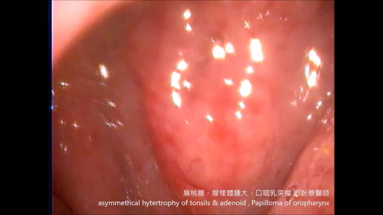 扁桃腺腫瘤 Lauranes