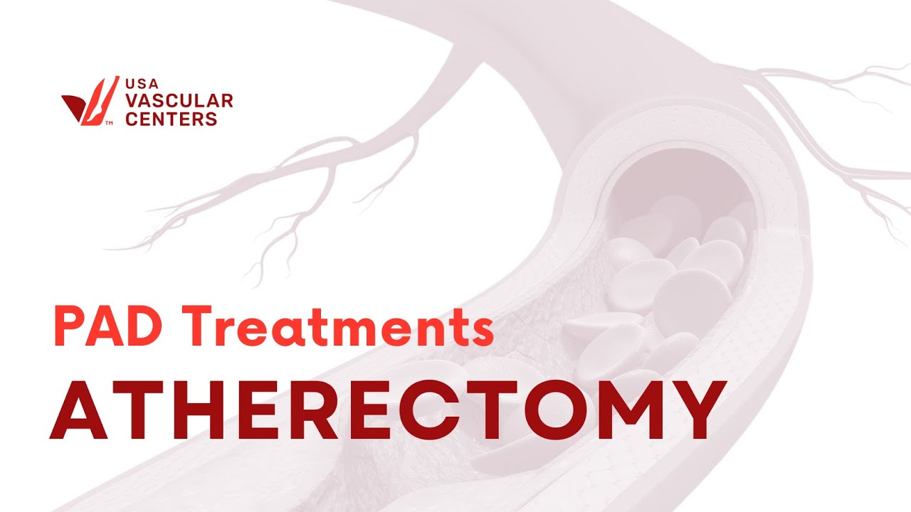Treating PAD - What is an Atherectomy?