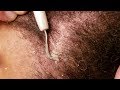 Dandruff Scratching Flaky Edges Removal With Dental Pick