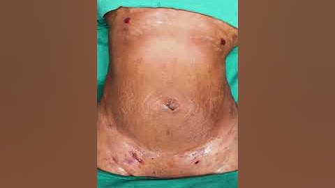 360° Abdomen Liposuction result | Liposuction result | Liposuction video | Liposuction Surgery