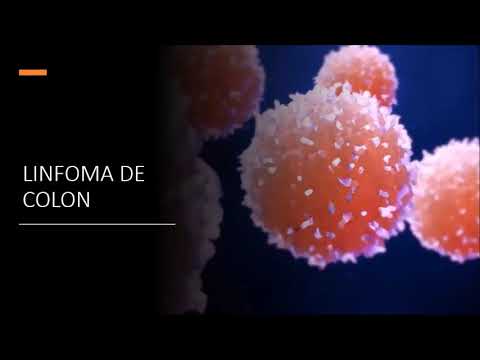 Cáncer de recto, metástasis a cólon y linfoma de cólon