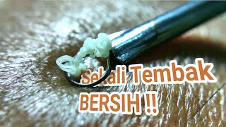 3 Cara Mengatasi Jerawat Batu