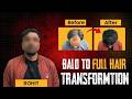 From Fear to Full Hair: Life-Changing Hair Transplant Journey at SkinQure