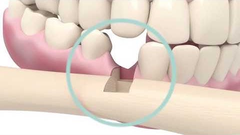 nanoXIM•Medical || Regenerating bone