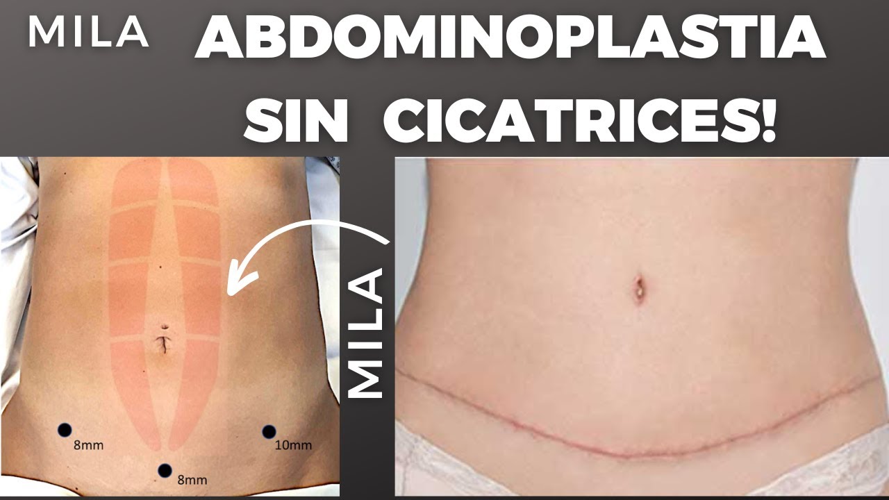 ABDOMINOPLASTIA sin cortes y SIN CICATRICES es posible y se llama MILA ...