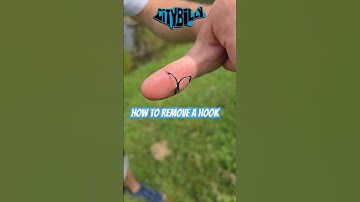 How To Remove A Treble Hook From Your Hand #fishing