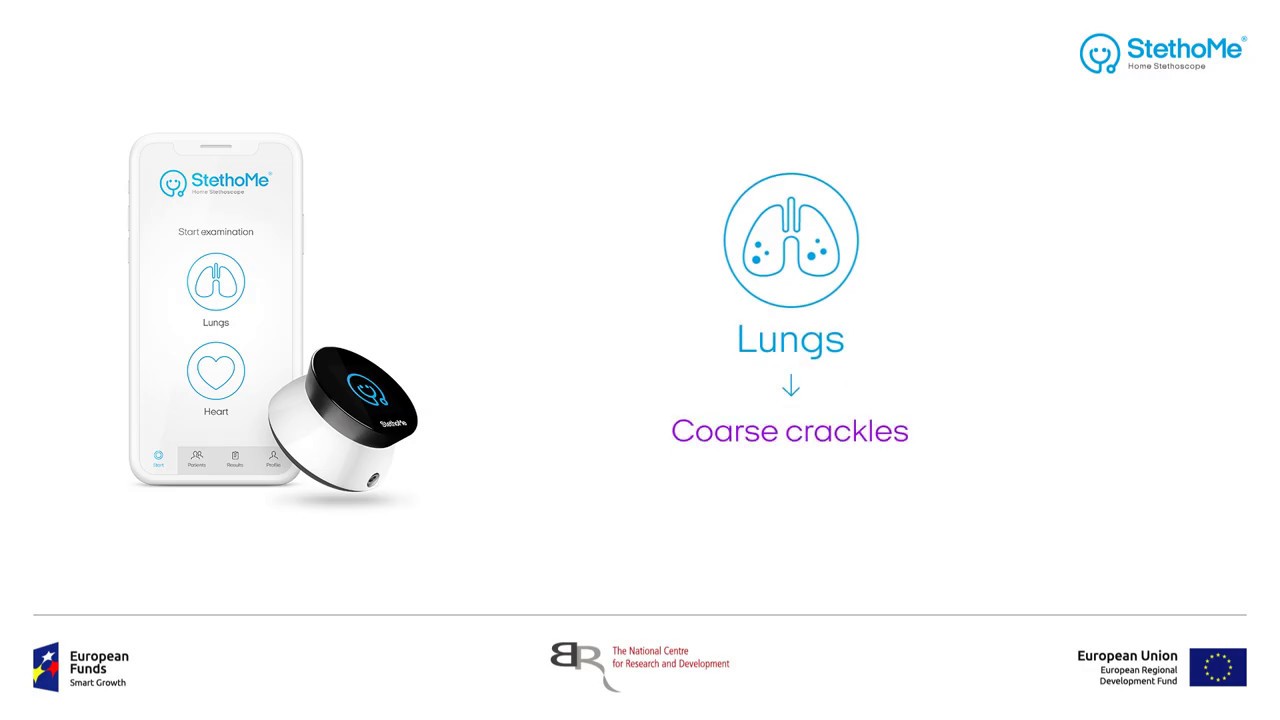 Crackles- Pulmonary Edema