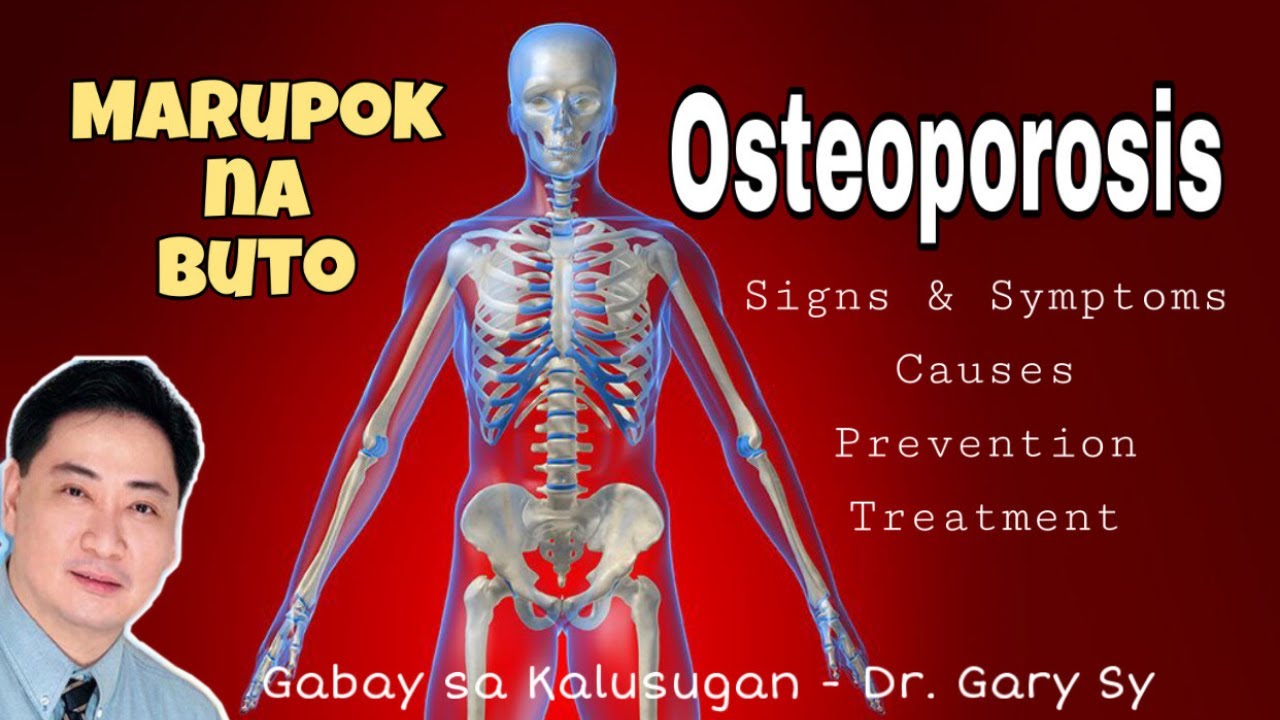 Osteoporosis - Dr. Gary Sy