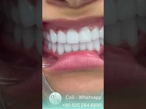 أحصل على ابتسامة هوليود في تركيا