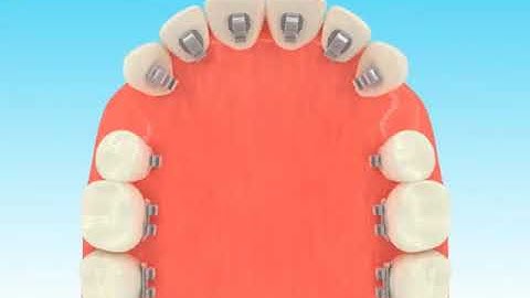 Niềng Răng Mắc Cài Mặt Lưỡi