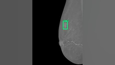 An Accurate Breast Cancer Detection  using Deep learning Method