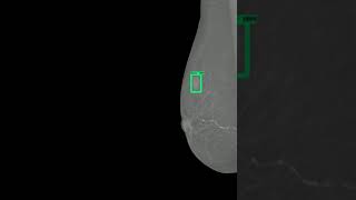 An Accurate Breast Cancer Detection  using Deep learning Method