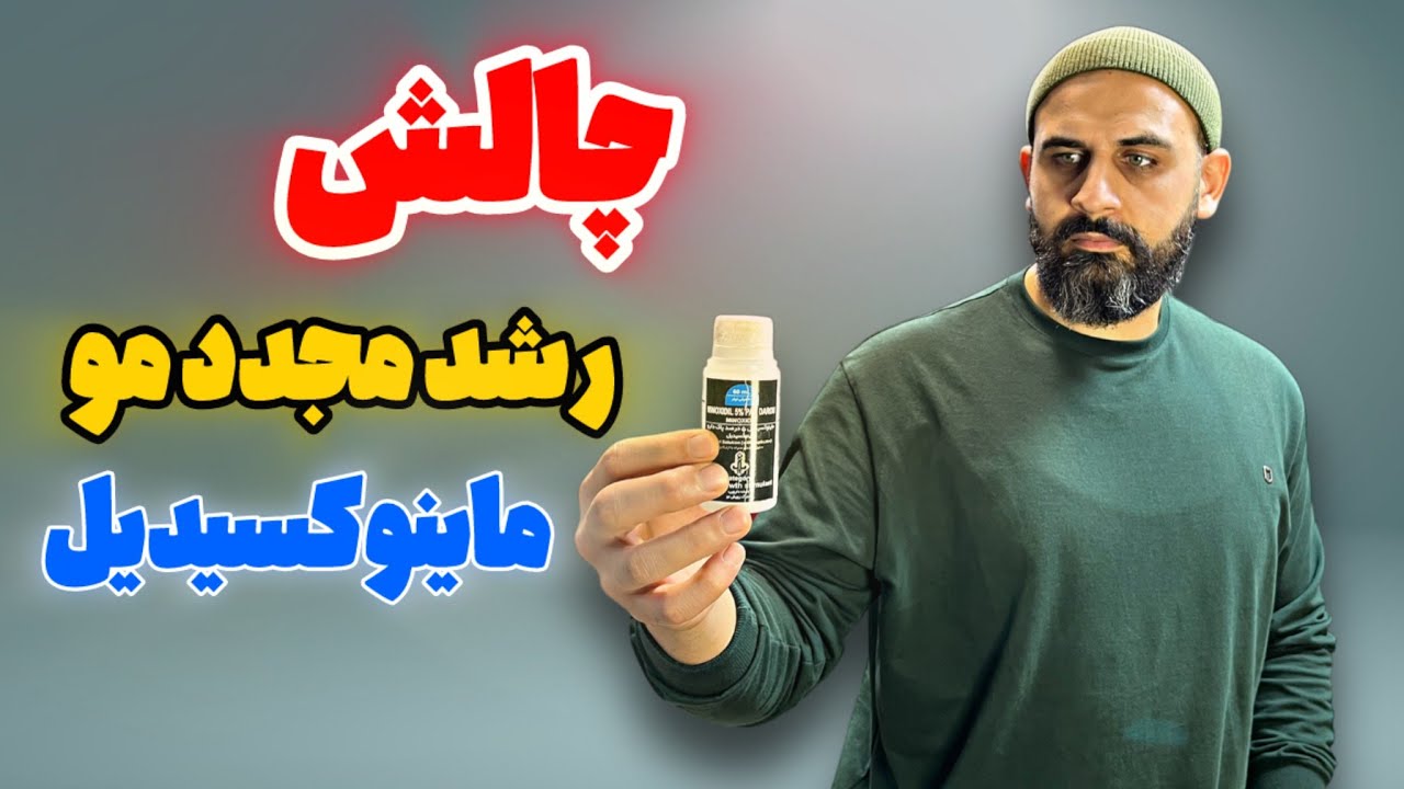 چالش رشد مجدد مو(ماینوکسیدیل)