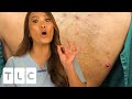 Deep Cysts, Chicken Fillets & Steatocystomas Under The Microscope | Dr Pimple Popper: This Is Zit