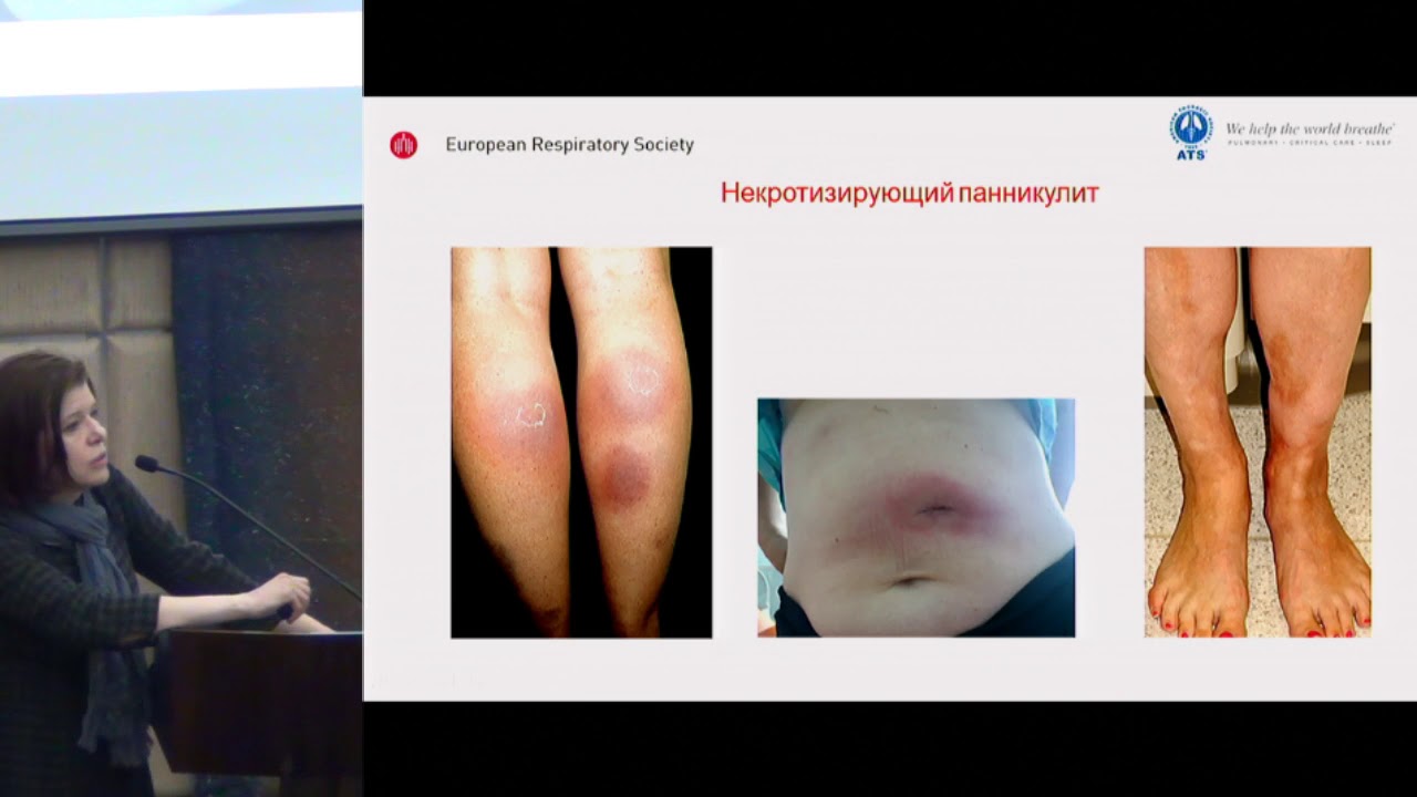 Карчевская Н.А., Дефицит альфа-1-антитрипсина.