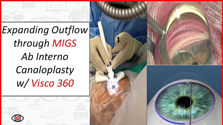 Expanding Outflow through MIGS Ab Interno Canalopl...