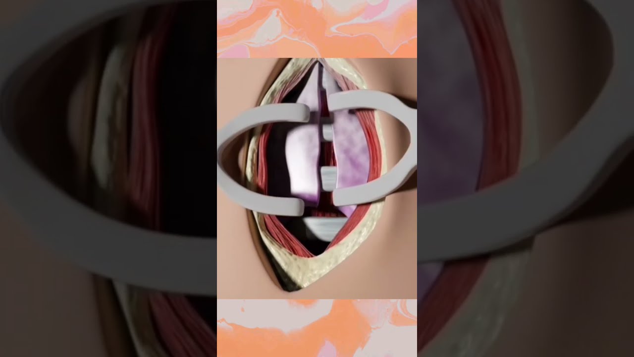 Tracheostomy Procedure In 3D Animation