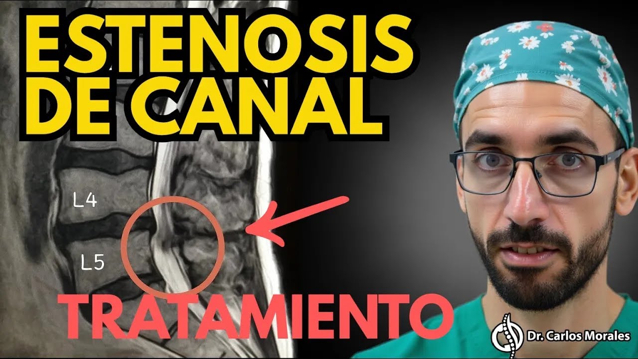 Estenosis de Canal: ¿Necesitas CIRUGÍA? (La verdad que nadie te cuenta) 🤫