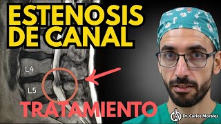 Estenosis De C Necesitas Cirugía? La Verdad Que Nadie Te Cuenta
