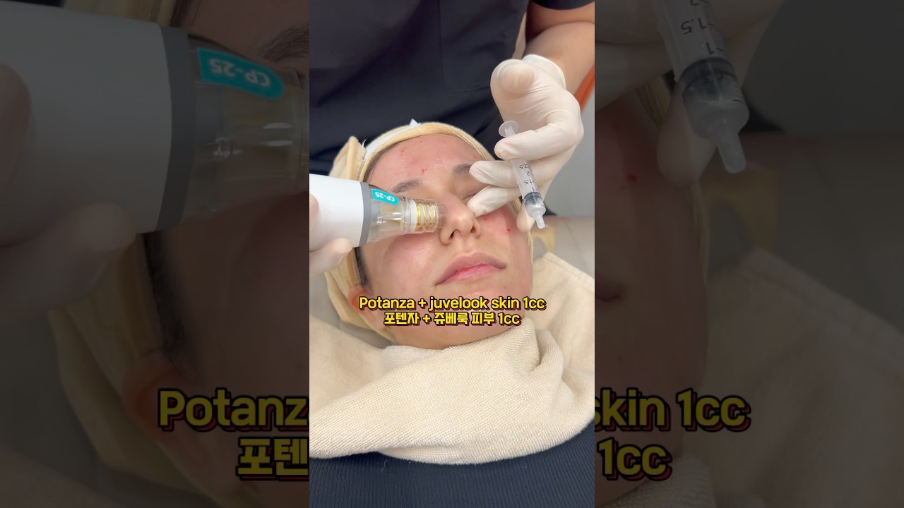 [Бьюти Блоссом Клиник] Потенца шилэн лифт 🤩 #шилэн_арьс#потенца#лифтинг#лифтинг_эффект#гоо_сайхан#ботокс_үйлчилгээ#солонгос#гэрэлтэх#сөүл#дерма