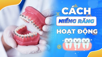 Niềng Răng Hoạt Động Như Thế Nào Vậy? | Nam Bùi Vinalign