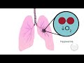 How Anesthesiologists Can Help With Transfusion related Acute Lung Injury