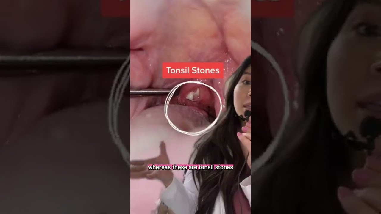 What Inflamed Tonsils Look Like Vs Normal Tonsilstones